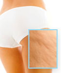 celulitis