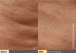 Cellulaze_BeforeAftersLineup_HR2