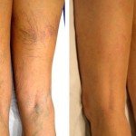Tratamientos varices
