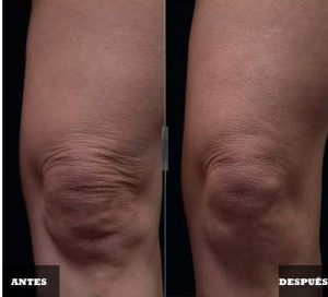 rodillas thermage