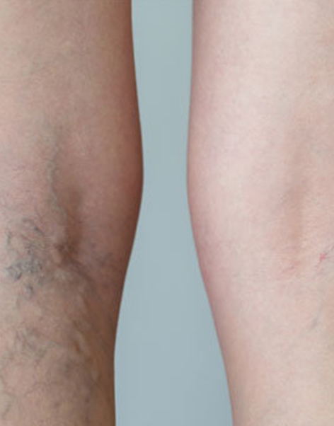 Láser vascular