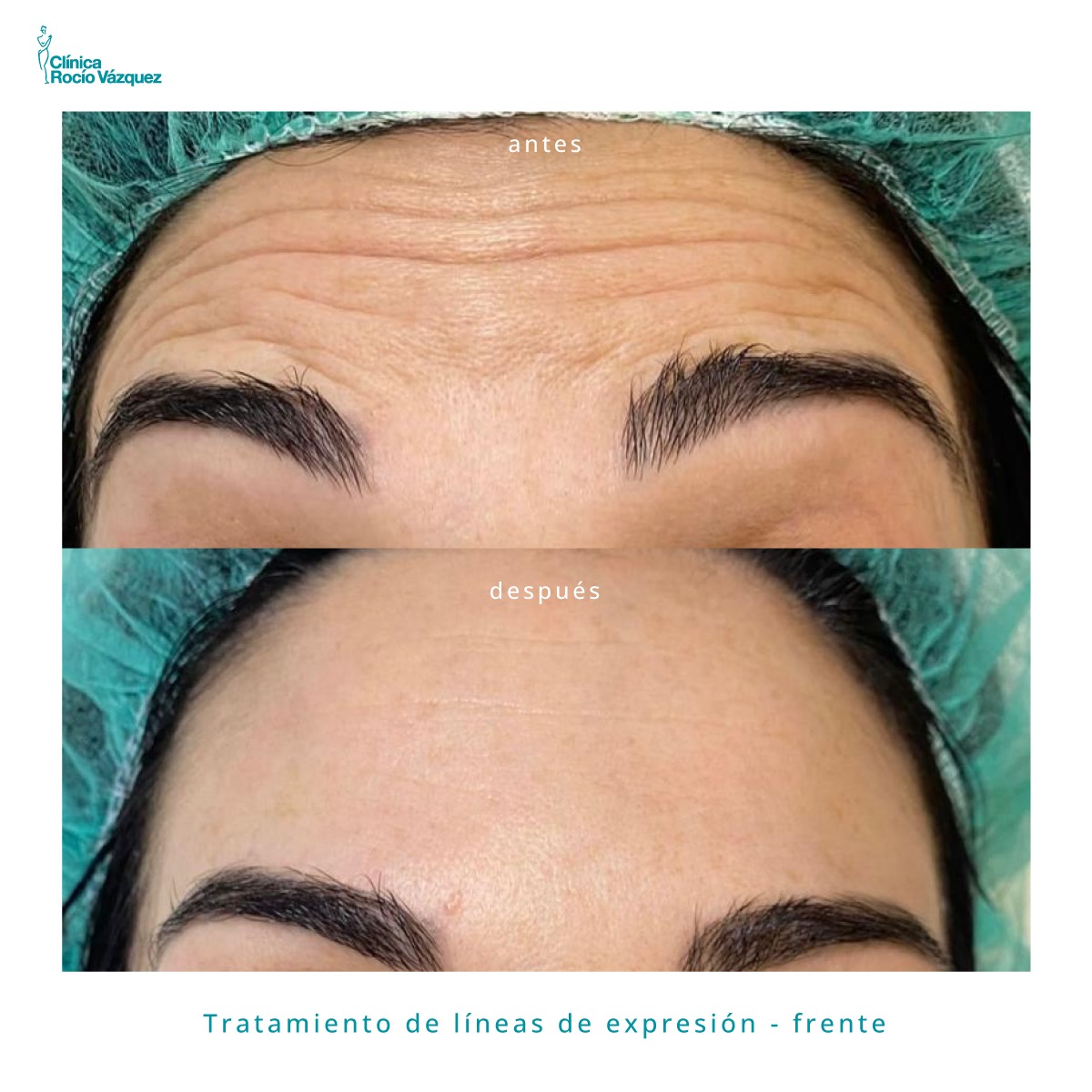 antes y despues toxina butolinica