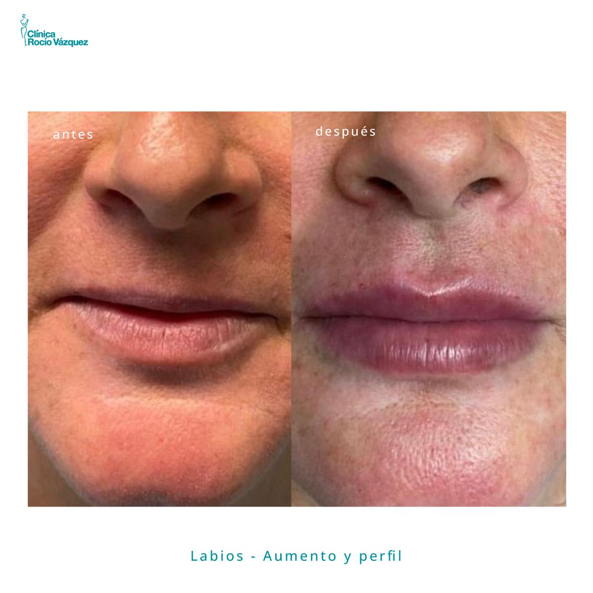 medicina estetica labial en andalucia
