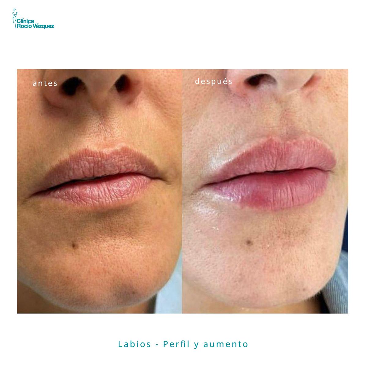 medicina estética labios