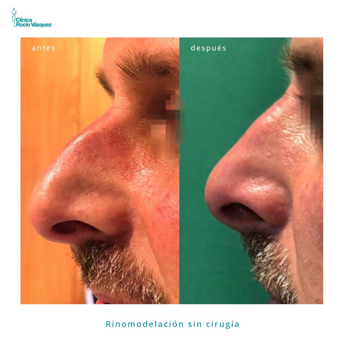 antes y despues rinomodelacion
