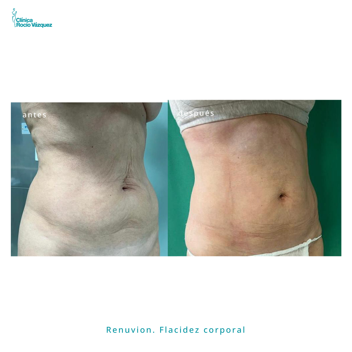 renuvion abdomen flacidez corporal